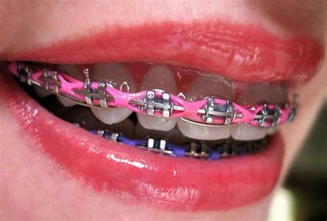 double power chain braces.